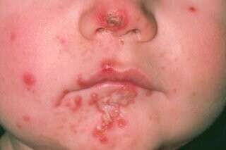 Mũi và xung quanh miệng của trẻ bị loét đỏ do bệnh chốc.  Nguồn ảnh: www.nhs.uk