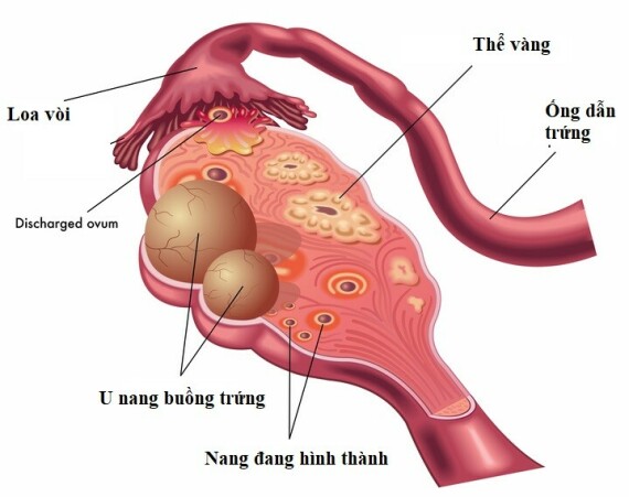 U nang buồng trứng là một khối chứa dịch hoặc chất rắn có dạng như bã đậu phát triển bất thường trên hoặc bên trong buồng trứng – Nguồn ảnh: universityhealthnew.com