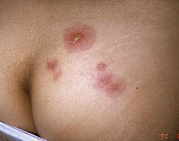 Triệu chứng của nhiễm khuẩn âm đạo gồm khí hư, kích ứng, ngứa, ban đỏ - Nguồn ảnh: buoyhealth.com