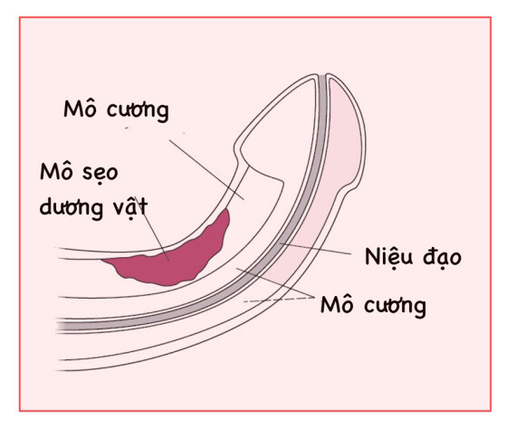 Bệnh Peyronie là một nguyên nhân dẫn đến chứng rối loạn cương dương ở nam giới, nguồn ảnh msdmanuals.com