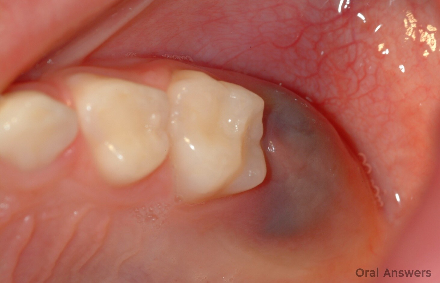 Nang mọc răng là một túi mô mềm chứa đầy chất lỏng của răng mới mọc, xuất hiện trước khi răng mọc, thường có màu xanh lam hoặc trong. (nguồn: oralanswers.com)