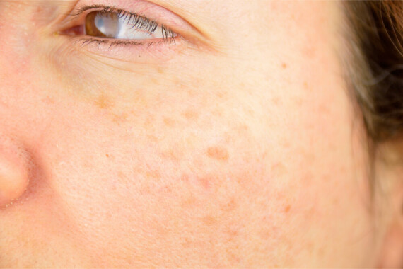 brown-spots-on-face - Vargas Face and Skin Center