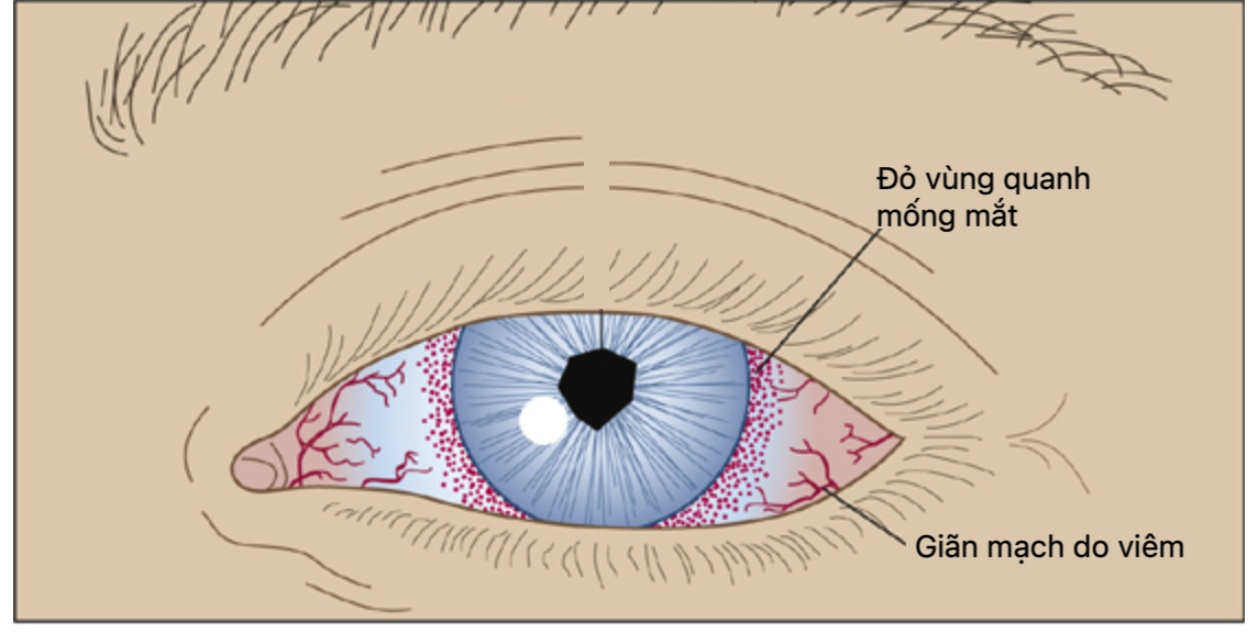 DiagramDescription automatically generatedViêm màng bồ đào (Nguồn ảnh: https://aneskey.com)