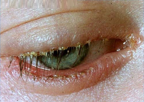 Các triệu chứng chính của viêm bờ mi bao gồm kích ứng, ngứa và vảy giống như gàu trên mí mắt.(nguồn: howtorelief.com)