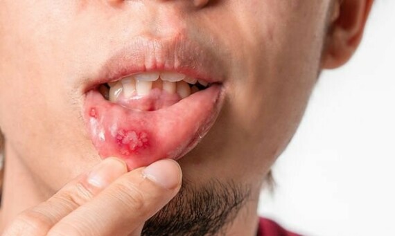 Viêm loét niêm mạc miệng là một dấu hiệu cảnh báo của sự thiếu hụt vitamin B12. Nguồn ảnh: porncyberclub.com