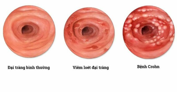 Viêm loét đại tràng và bệnh Crohn là hai nguyên nhân phổ biến gây bệnh viêm ruột – Nguồn ảnh: drugwatch.com