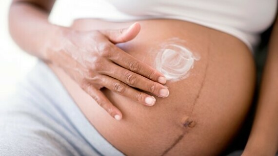 Dưỡng ẩm và massge giúp hạn chế rạn da khi mang thai. Nguồn ảnh: https://www.whattoexpect.com/