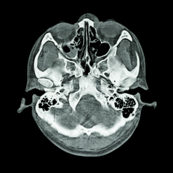 Hình ảnh sọ não trên phim chụp CT (nguồn: https://two-views.com/)