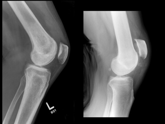 Hình ảnh XQ khớp gối mô tả xương bánh chè bị di lệch xa vị trí bình thường trong đứt gân tứ đầu đùi trái (Nguồn ảnh từ Dralexjimenez).