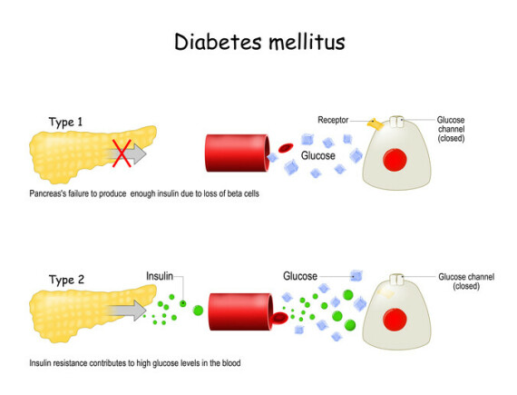 Tụy không sản xuất được insulin dẫn đến đái tháo đường týp 1 (nguồn: https://www.painscale.com/)