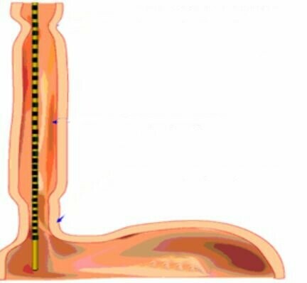 Đo vận động thực quản. Nguồn: vinmec.com