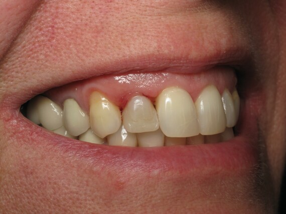 Shaping And Forming Gum Around Front Teeth Dental Implants - Ramsey Amin  DDS Reviews - Ramsey Amin, DDSVùng lợi xung quanh chụp răng sưng nề, đau hoặc chảy máu là dấu hiệu của viêm lợi. Nguồn ảnh: dentalsoft.com