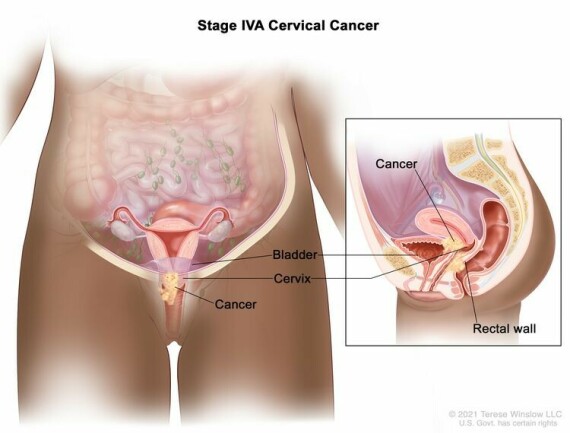 Giai đoạn IVA ung thư cổ tử cung. Ung thư đã lan đến các cơ quan lân cận, chẳng hạn như bàng quang hoặc trực tràng.