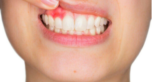 Áp xe răng là một tình trạng khá khó chịu và đau đơn. Nguồn ảnh: yorkhillendodontics.com