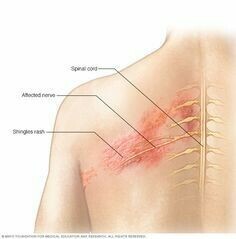 Mụn nước Zona tại vị trí các dây thần kinh (nguồn ảnh : mayoclinic.org) Mụn nước Zona tại vị trí các dây thần kinh (nguồn ảnh : mayoclinic.org) 