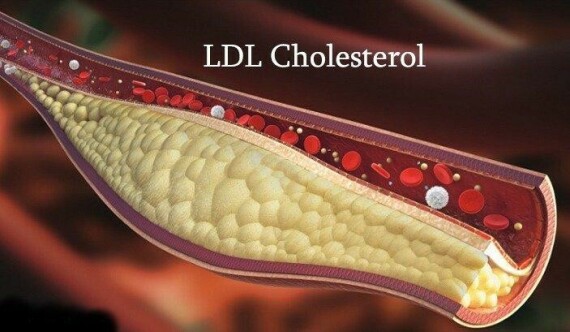 Mức LDL cholesterol cao làm tăng nguy cơ hình thành mảng xơ vữa động mạch. Nguồn ảnh: healthcheckup.com