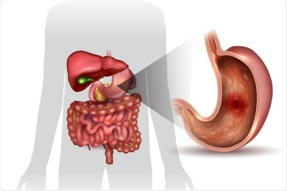 Thuốc trung hòa axit không có nhiều tác dụng trong chữa lành các vết loét (nguồn ảnh: https://www.news-medical.net/)