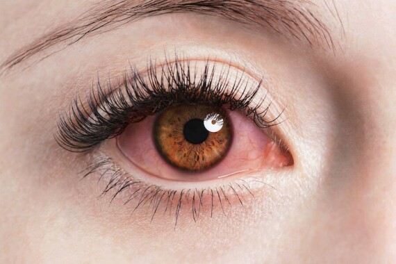 Cloramphenicol được dùng trong trường hợp đau mắt hột và các nhiễm trùng mắt.   Nguồn ảnh: hemifar.be