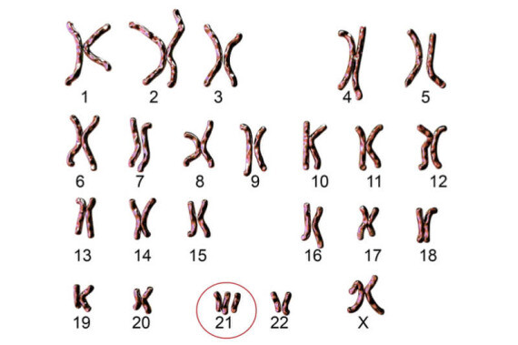 Hội chứng Down là tình trạng trẻ sinh ra có thêm một bản sao của nhiễm sắc thể thứ 21 – do đó có tên khác là tam nhiễm sắc thể 21. (nguồn: labiotech.eu)