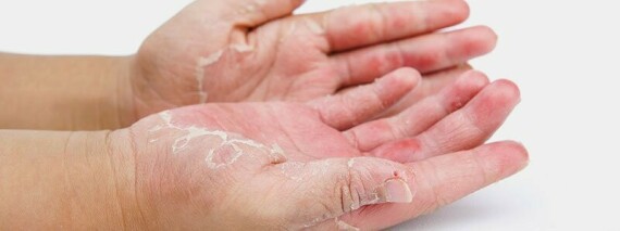 Sử dụng Tacrolimus có thể gây eczema