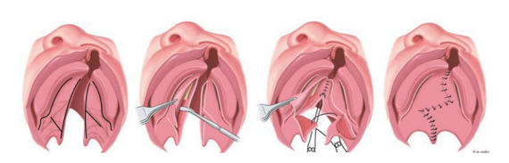 Hình ảnh các vết cắt hoặc vết rạch trên vòm miệng và sau đó da được nới lỏng ra khỏi khẩu cái cứng như thế nào.