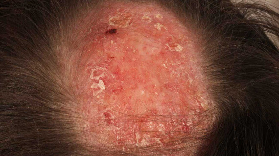 Rụng tóc trong bệnh lupus có dạng rụng tóc từng mảng, kèm theo các tổn thương trên da đầu. (nguồn: healthline.com)