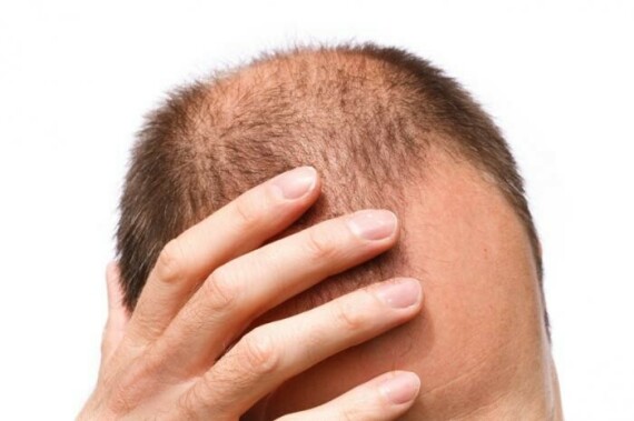 Nồng độ progesterone thấp ở nam giới có thể dẫn đến rụng tóc. (Nguồn ảnh medicalnewstoday.com)