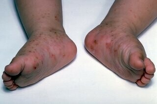 Bàn chân của trẻ có nhiều nốt đỏ sẫm do ghẻ, có thể mẩn đỏ xung quanh.  Nguồn ảnh: www.nhs.uk