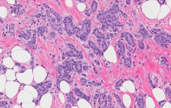 Hình ảnh sinh thiết của ung thư biểu mô ống dẫn sữa xâm lấn, nguồn ảnh mypathologyreport.ca