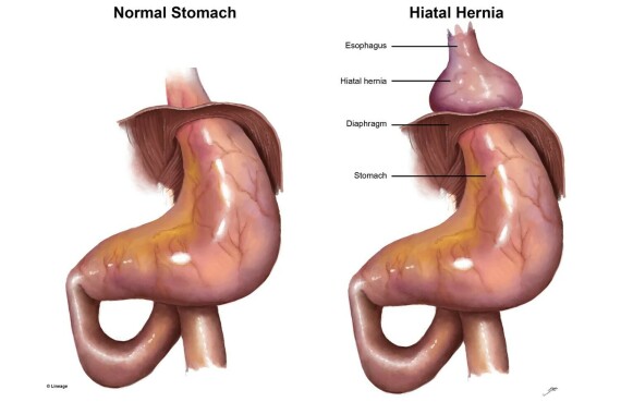 Thoát vị khe hoành – Nguồn ảnh: step2.medbullets.com