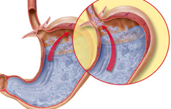 IMG_256Xít dạ dày trào ngược lên thực quản là triệu chứng trào ngược dạ dày-thực quản. Nguồn ảnh: bcare.vn 