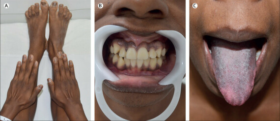 Hình: Tăng sắc tố da, niêm mạc trong bệnh Addison. Nguồn: The Lancet