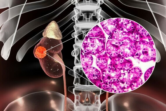 Ung thư biểu mô tế bào thận, nguồn ảnh drugtargetreview.com