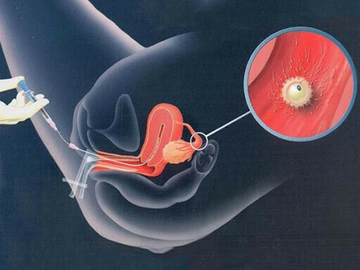Quá trình thụ tinh trong tử cung. Nguồn: Đại học Buôn Mê Thuột
