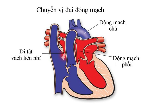 Chuyển vị đại động mạch. Nguồn ảnh: heart.org