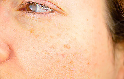 What can get rid of age spots?