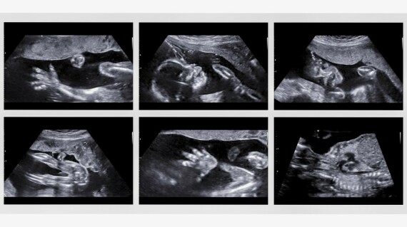 Hình: Siêu âm thai từ 18 đến 20 tuần. Nguồn: Healthline