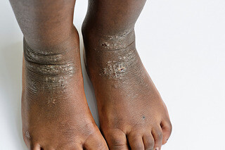 Các mảng da sẫm màu, đóng vảy trên mắt cá chân và bàn chân trẻ do bệnh viêm da cơ địa trên làn da nâu sẫm.Nguồn ảnh: www.nhs.uk