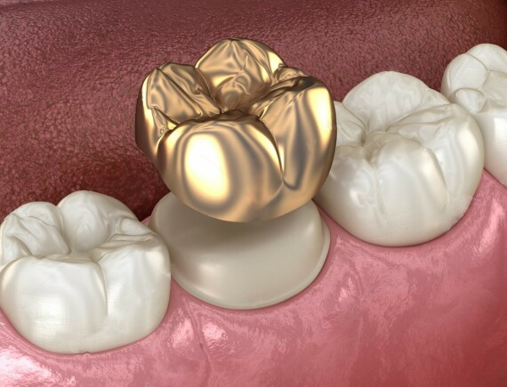 Gold Dental Crowns - Safar MedicalChụp răng kim loại quý. Nguồn ảnh: Safarmedical.com