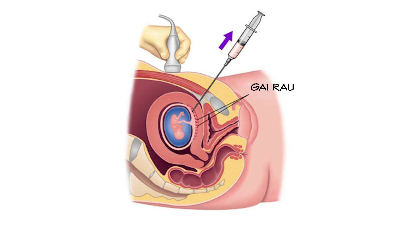    Sinh thiết gai rau. Nguồn ảnh: nfmc.in