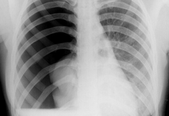 Tràn khí màng phổi trên phim X quang