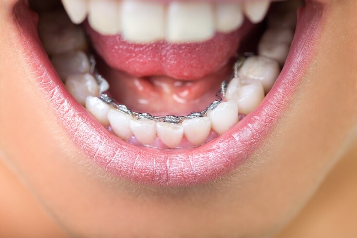 Mắc cài mặt lưỡi, nguồn https://www.tretterortho.com 