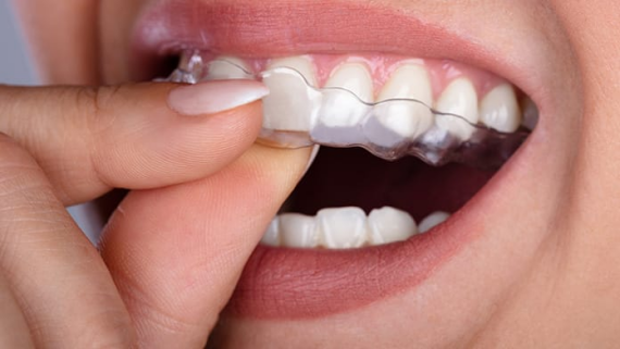 Khay làm trắng được đeo vào xung quanh răng giống như miếng bảo vệ miệng và chứa dung dịch làm trắng dạng gel có peroxide. (nguồn: smilekliniek.be)