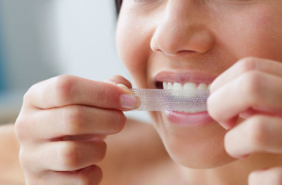 Miếng dán làm trắng răng được đeo trong khi thực hiện các hoạt động khác và khi hết thời gian đeo (thường là khoảng 30 phút) thì sẽ được bỏ đi. (nguồn: health.clevelandclinic.org)
