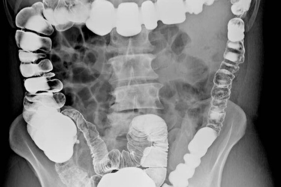 Một chất lỏng có chứa bari được bơm vào đại tràng qua hậu môn, giúp làm cho khung đại tràng có thể nhìn thấy rõ hơn trên X-quang. (nguồn: mydr.com.au)