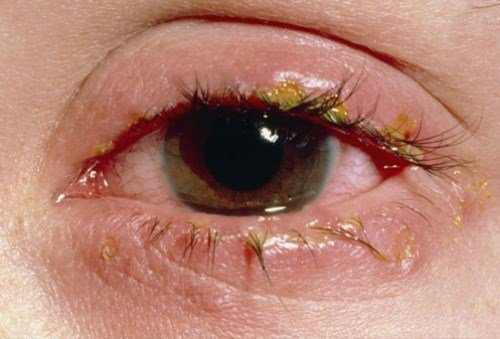 Sau khi nhỏ thuốc có thể có các kích ứng tại mắt gây ngứa mắt, nóng rát tại chỗ