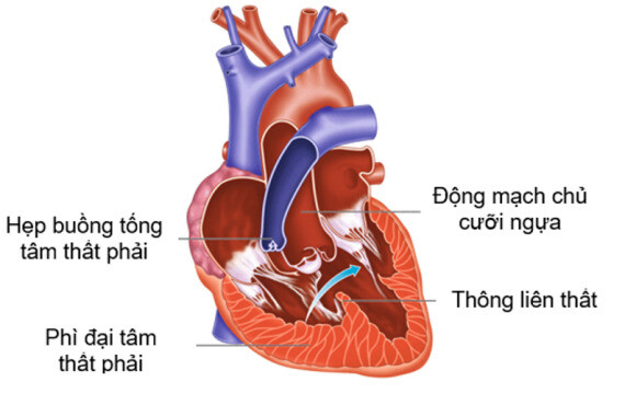 Tứ chứng Fallot – dị tật thường gặp nhất trong nhóm tim bẩm sinh có tím. Nguồn ảnh: tamduchearthospital.com