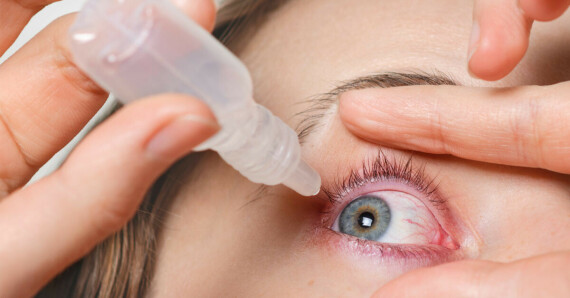 Dùng nước mắt nhân tạo nhiều lần trong ngày để giúp giảm các triệu chứng. (Nguồn ảnh doctordoctor.com.au)