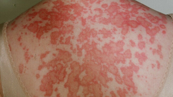 Lupus có thể gây phát ban đỏ trên da (Nguồn: healthline)