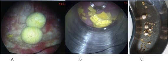 A: Hình ảnh sỏi bàng quang. B: Hình ảnh sỏi sau khi tán. C: Sỏi sau khi được lấy ra ngoài.  (Nguồn ảnh sciencedirect.com)